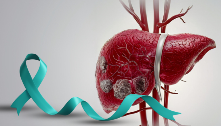 Liver Cancer