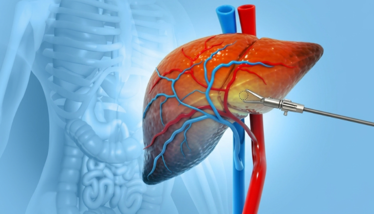 Acute Liver Failure