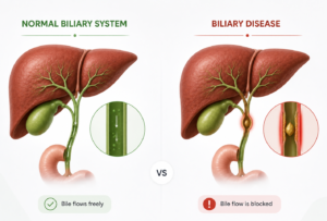 Normal-vs-obstructed-bile-duct