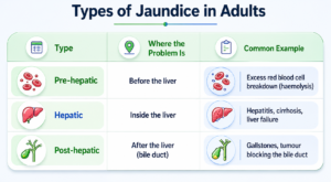 Infographic showing the three main types of jaundice in adults — pre-hepatic, hepatic, and post-hepatic — with liver and bile duct illustrations and common clinical causes. 