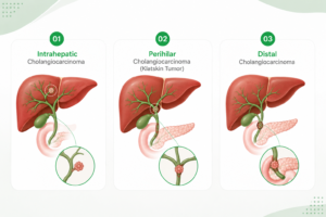 Infographic showing types of bile duct cancer including intrahepatic, perihilar (Klatskin tumour), and distal cholangiocarcinoma with liver and bile duct anatomy illustration.