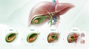 STAGES-OF-GALLBLADDER-CANCER