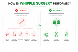 Whipple surgery infographic showing the two main stages of the procedure: removal of the pancreatic head, duodenum, gallbladder, bile duct, and lymph nodes, followed by reconstruction of digestive connections between the pancreas, bile duct, stomach, and intestine.