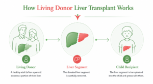 Living donor liver transplant infographic showing a parent donating a liver segment to a child recipient during pediatric liver transplantation.