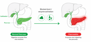 Medical infographic explaining pancreatitis, a condition where digestive enzymes activate inside the pancreas, causing inflammation due to blocked ducts,gallstones, or alcohol use.