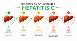 Progression of untreated Hepatitis C showing HCV infection, liver fibrosis, cirrhosis, liver failure, and liver cancer stages" 
