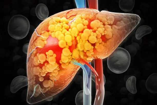 Liver Cirrhosis